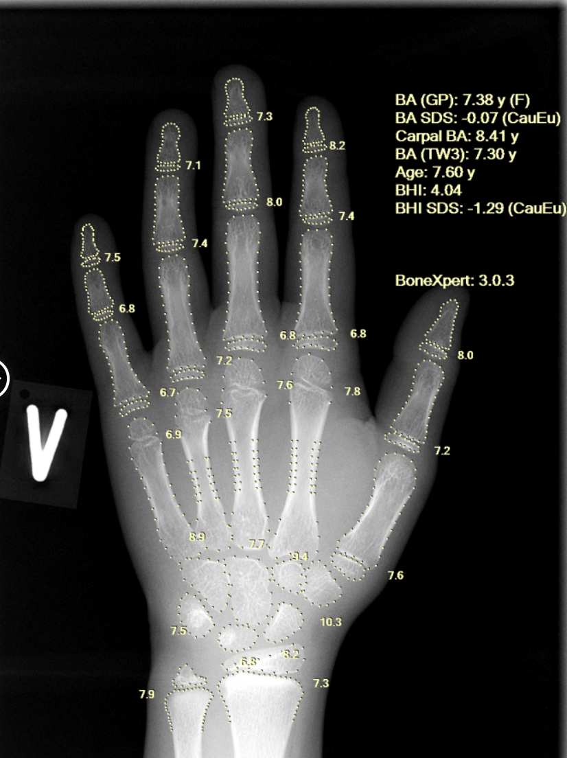 Aarthi Scans & Labs Rolls Out AI-Based Bone Age Technology across 100 Centres in India